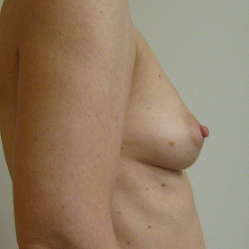 Nipple Sparing Breast Reconstruction Before & After Gallery - Patient 154952109 - Image 5