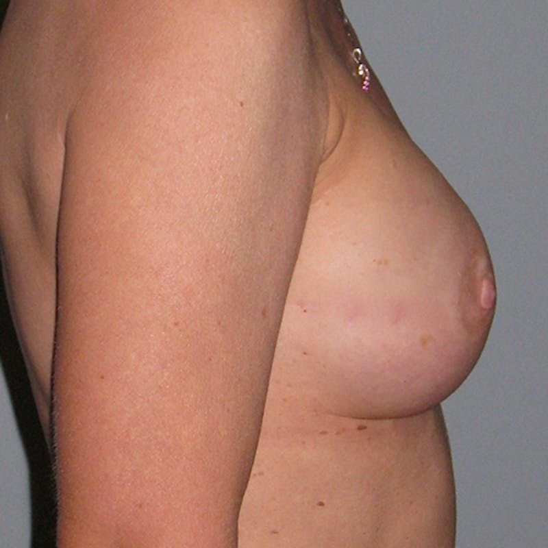 Nipple Sparing Breast Reconstruction Before & After Gallery - Patient 154952109 - Image 6