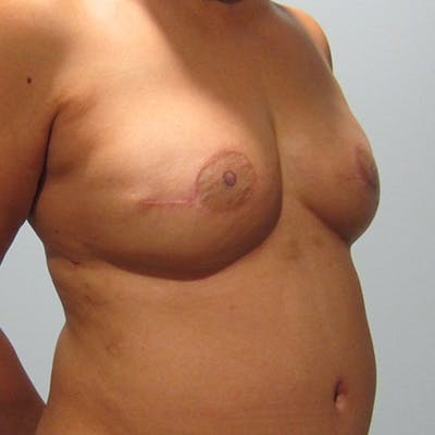 DIEP Flap Reconstruction Before & After Gallery - Patient 154952112 - Image 2
