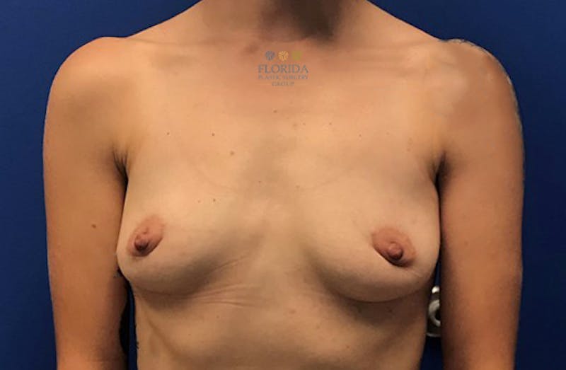 Breast Implant Removal Before & After Gallery - Patient 154952118 - Image 2