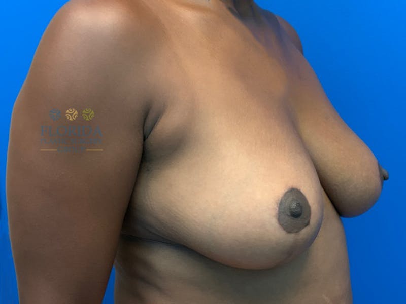 Breast Reduction Before & After Gallery - Patient 154952115 - Image 4