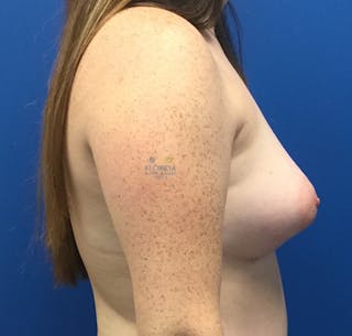 Silicone Breast Augmentation Before & After Gallery - Patient 154952119 - Image 4