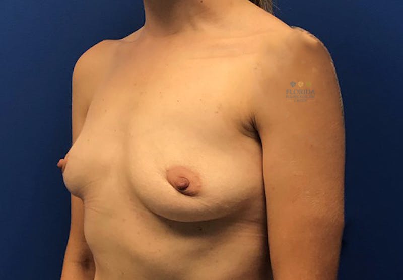 Breast Implant Removal Before & After Gallery - Patient 154952118 - Image 4