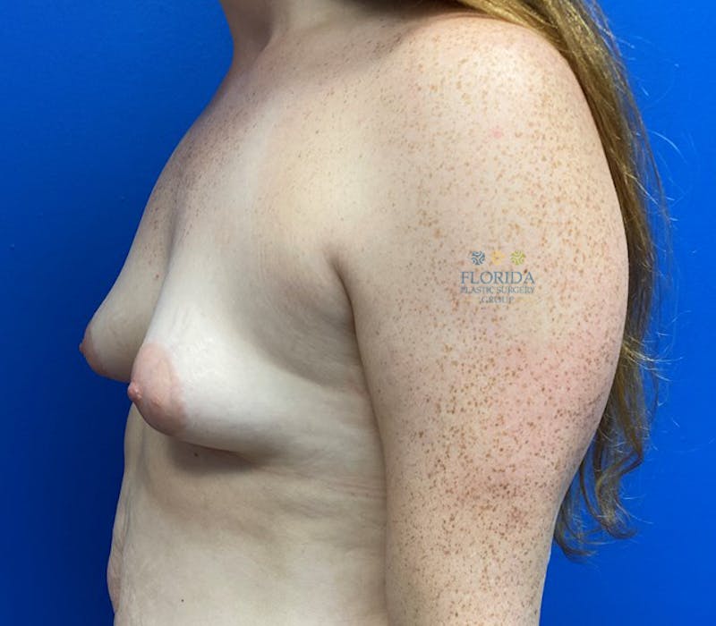 Silicone Breast Augmentation Before & After Gallery - Patient 154952119 - Image 5