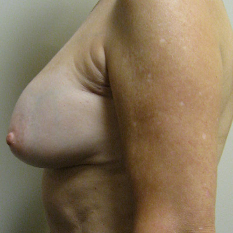 Nipple Sparing Breast Reconstruction Before & After Gallery - Patient 154952120 - Image 5
