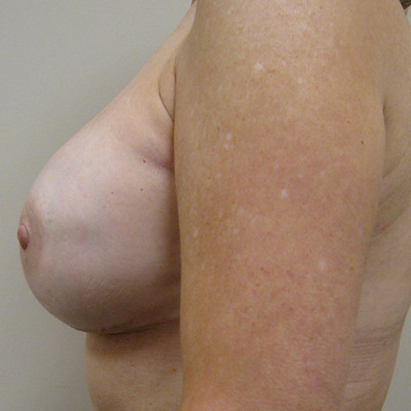 Nipple Sparing Breast Reconstruction Before & After Gallery - Patient 154952120 - Image 6