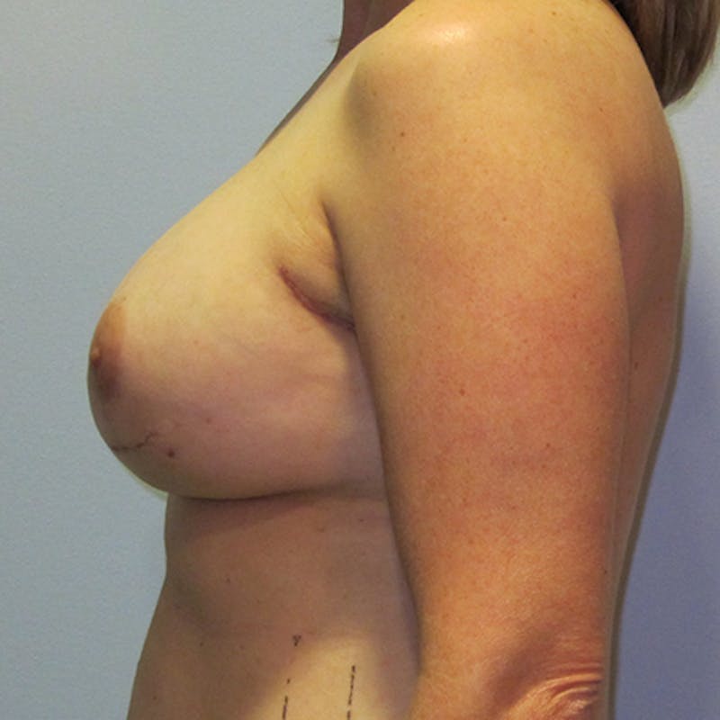 DIEP Flap Reconstruction Before & After Gallery - Patient 154952121 - Image 5