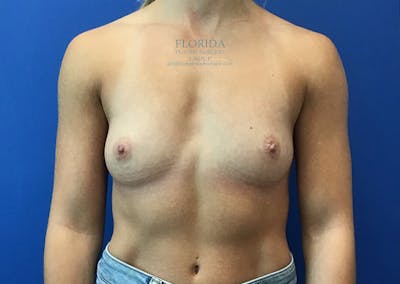 Silicone Breast Augmentation Before & After Gallery - Patient 154952134 - Image 1