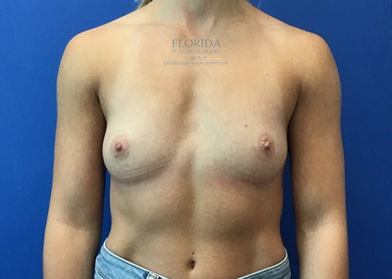 Silicone Breast Augmentation Before & After Gallery - Patient 154952134 - Image 1