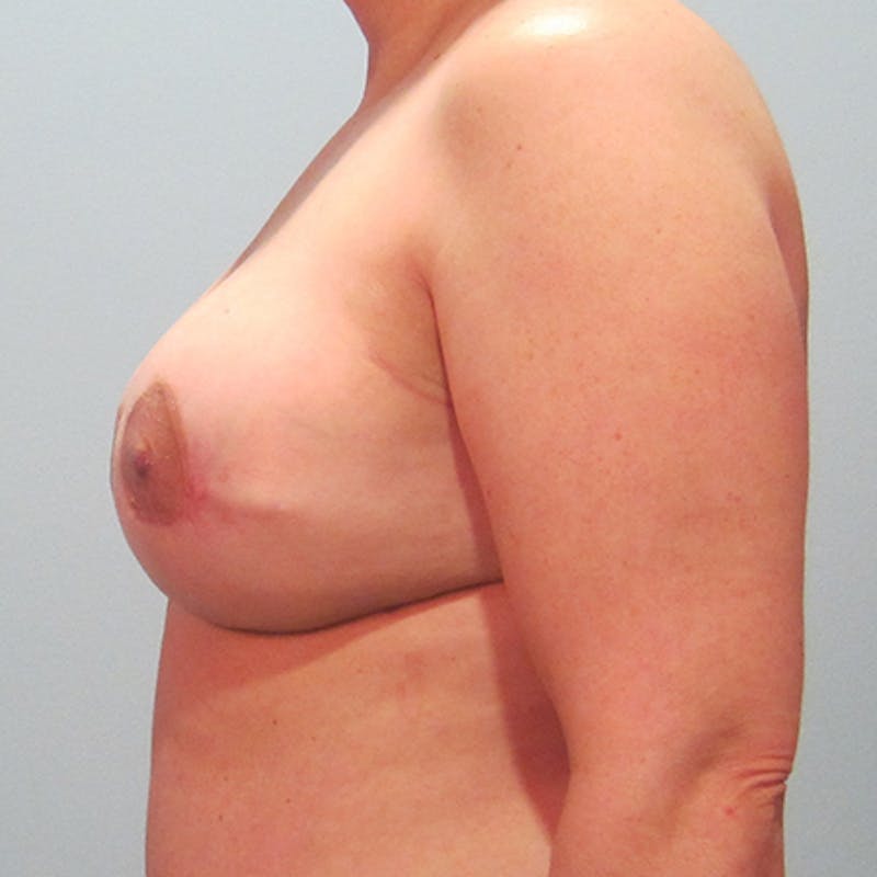 DIEP Flap Reconstruction Before & After Gallery - Patient 154952121 - Image 6