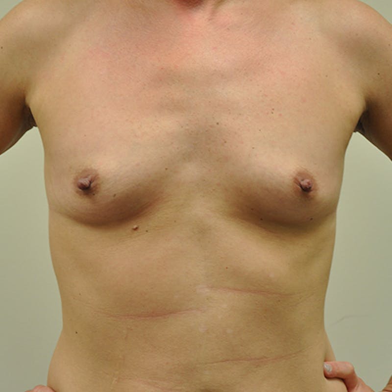 Nipple Sparing Breast Reconstruction Before & After Gallery - Patient 154952131 - Image 1