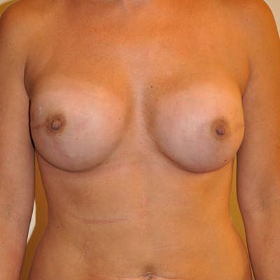 Nipple Sparing Breast Reconstruction Before & After Gallery - Patient 154952131 - Image 2