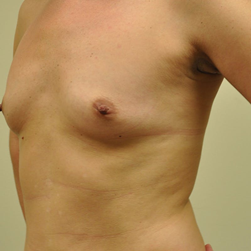 Nipple Sparing Breast Reconstruction Before & After Gallery - Patient 154952131 - Image 3