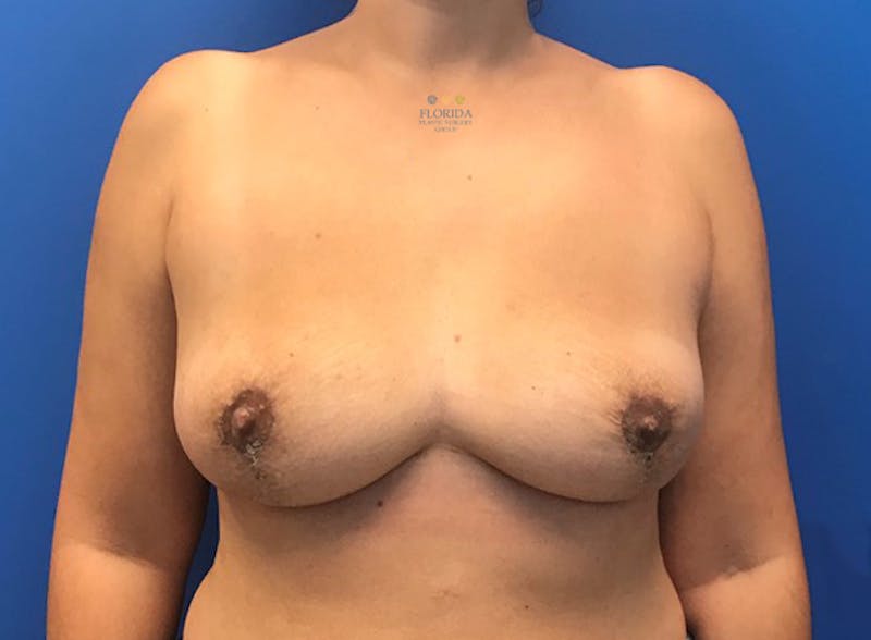 Breast Implant Removal Before & After Gallery - Patient 154952137 - Image 2
