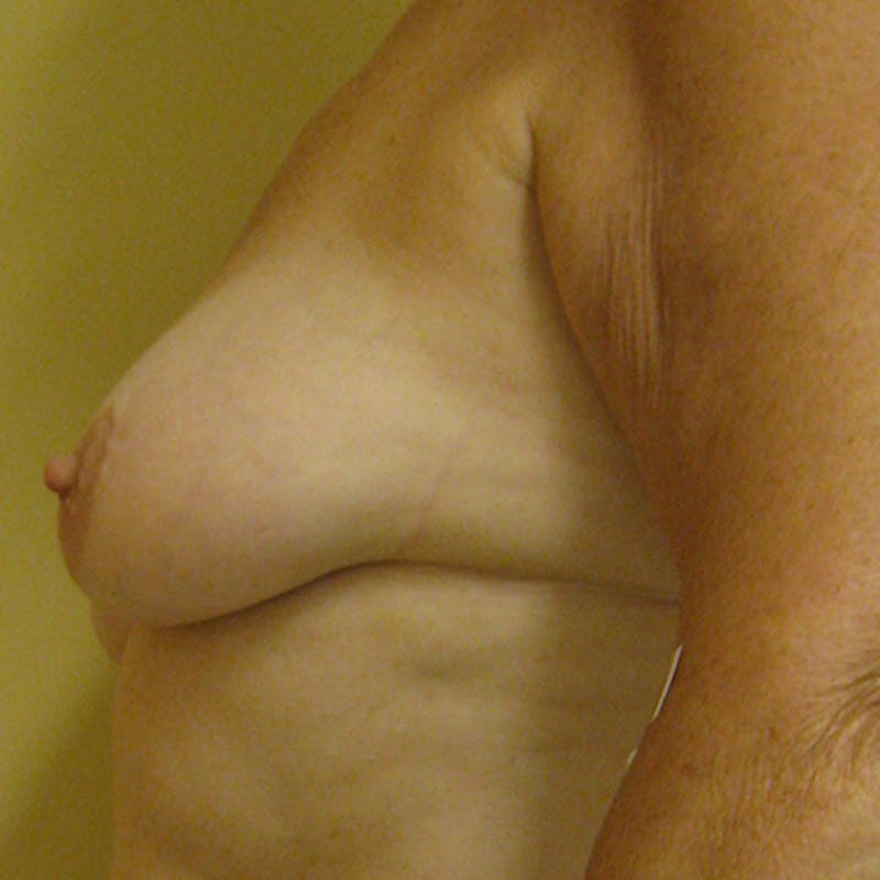 DIEP Flap Reconstruction Before & After Gallery - Patient 154952133 - Image 3