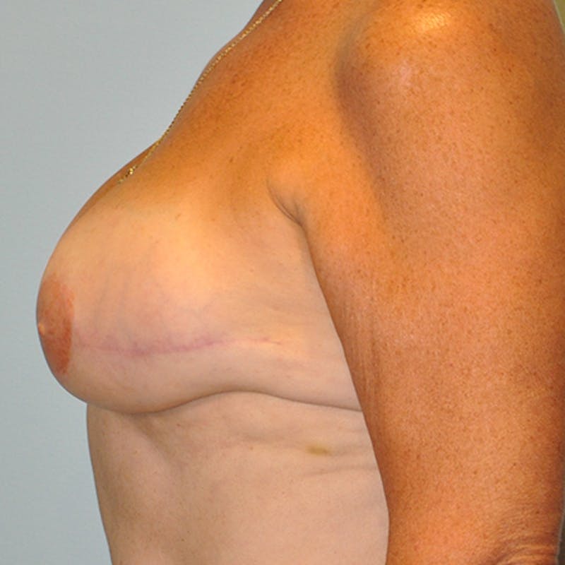 DIEP Flap Reconstruction Before & After Gallery - Patient 154952133 - Image 4