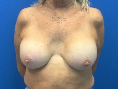 Nipple Sparing Breast Reconstruction Before & After Gallery - Patient 154952136 - Image 2