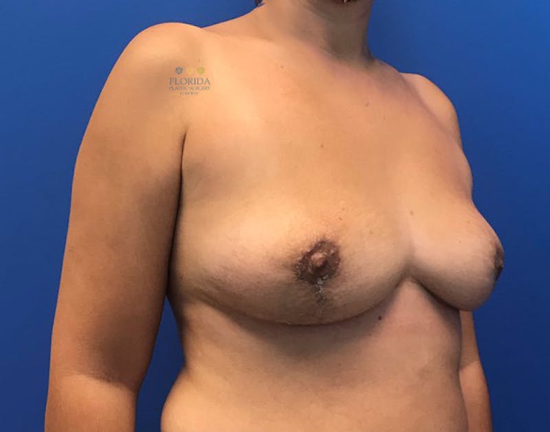 Breast Implant Removal Before & After Gallery - Patient 154952137 - Image 4