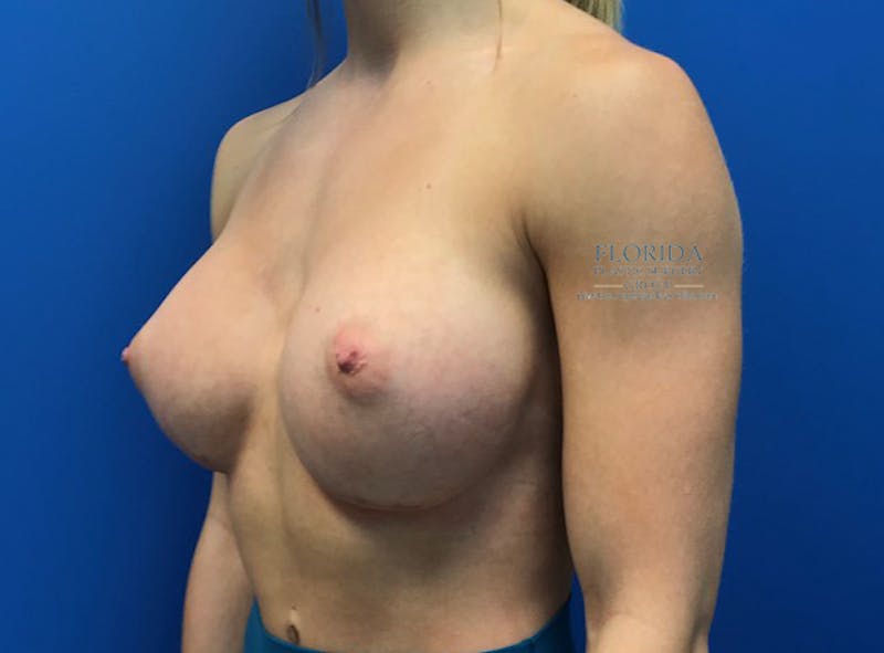 Silicone Breast Augmentation Before & After Gallery - Patient 154952134 - Image 6