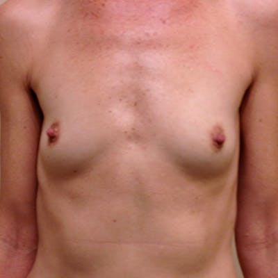 Silicone Breast Augmentation Before & After Gallery - Patient 154952138 - Image 1
