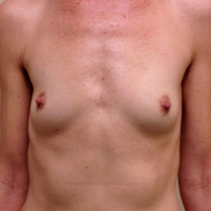 Silicone Breast Augmentation Before & After Gallery - Patient 154952138 - Image 1