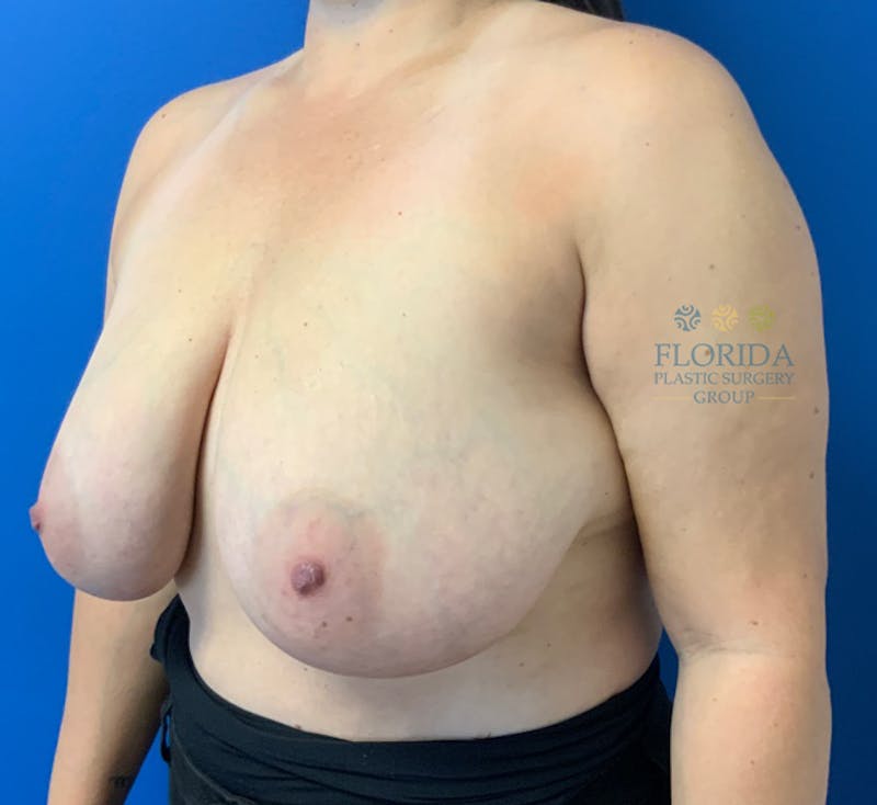 Breast Reduction Before & After Gallery - Patient 154952141 - Image 3
