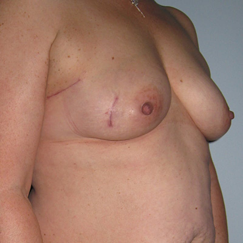 DIEP Flap Reconstruction Before & After Gallery - Patient 154952140 - Image 3