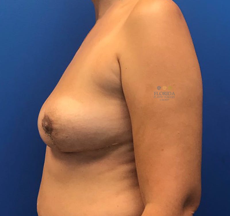 Breast Implant Removal Before & After Gallery - Patient 154952137 - Image 6