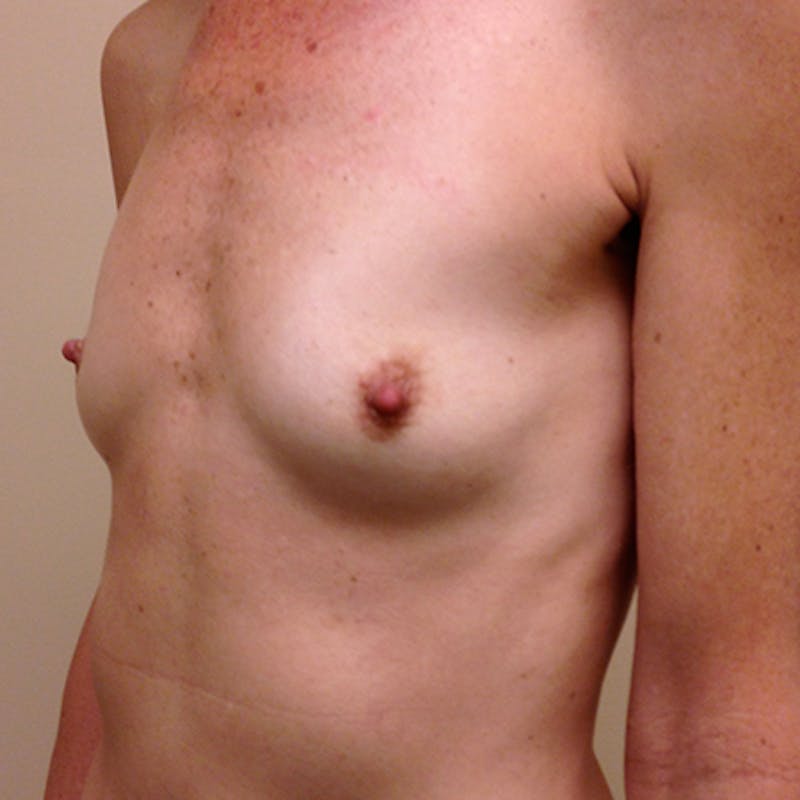 Silicone Breast Augmentation Before & After Gallery - Patient 154952138 - Image 3
