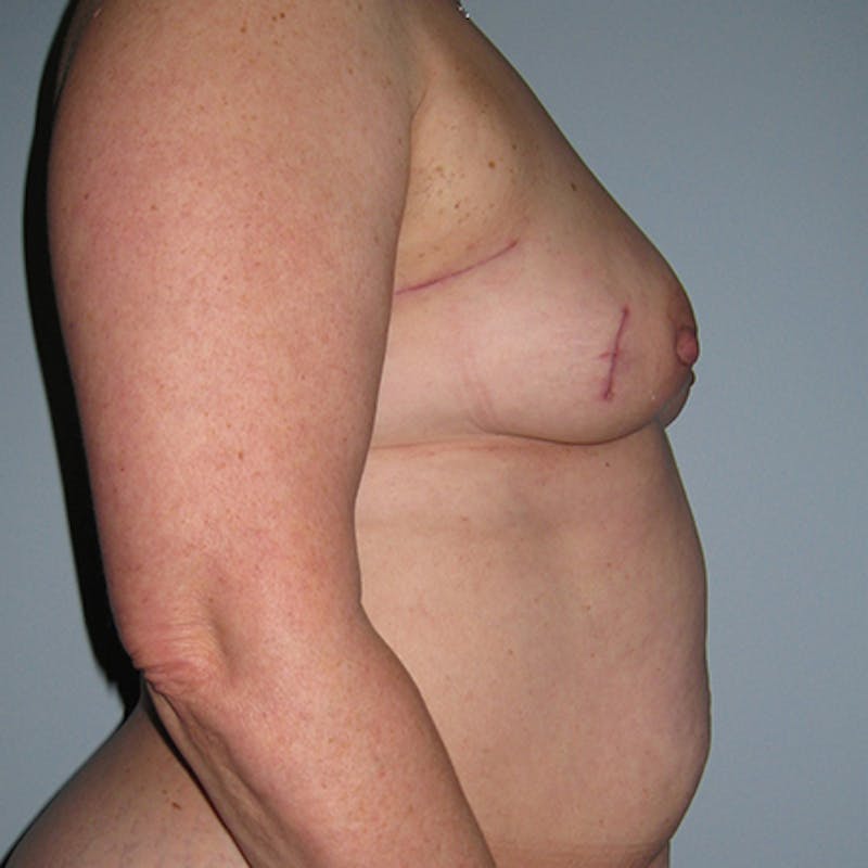 DIEP Flap Reconstruction Before & After Gallery - Patient 154952140 - Image 5