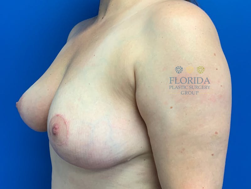 Breast Reduction Before & After Gallery - Patient 154952141 - Image 4