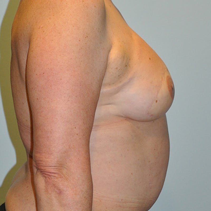 DIEP Flap Reconstruction Before & After Gallery - Patient 154952140 - Image 6