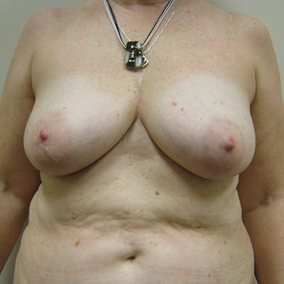 DIEP Flap Reconstruction Before & After Gallery - Patient 154952147 - Image 1