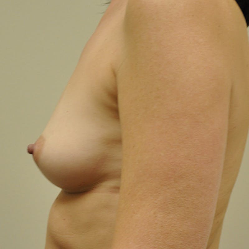 Nipple Sparing Breast Reconstruction Before & After Gallery - Patient 154952143 - Image 5
