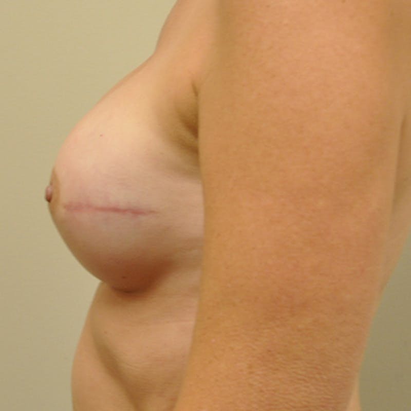 Nipple Sparing Breast Reconstruction Before & After Gallery - Patient 154952143 - Image 6
