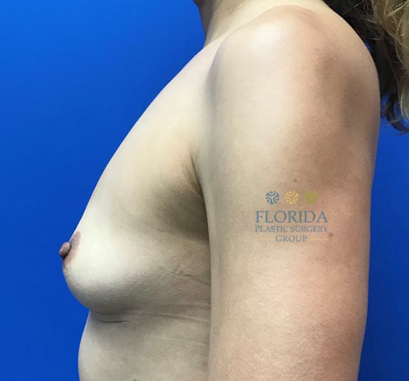 Breast Implant Removal Before & After Gallery - Patient 154952144 - Image 4
