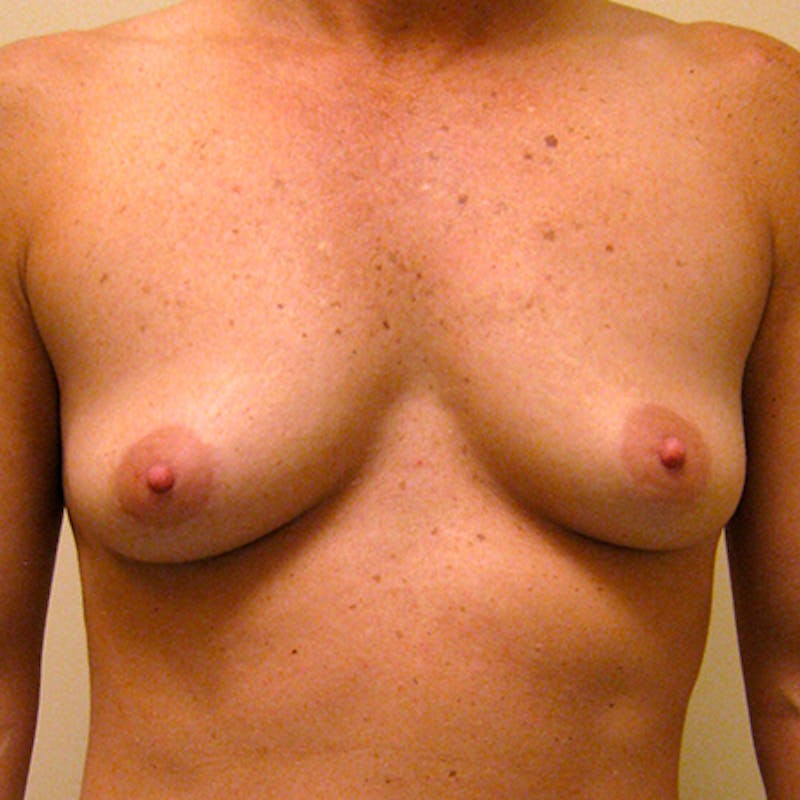 Silicone Breast Augmentation Before & After Gallery - Patient 154952148 - Image 1