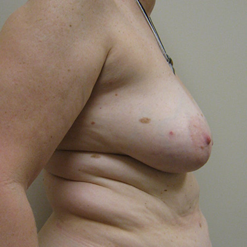 DIEP Flap Reconstruction Before & After Gallery - Patient 154952147 - Image 5