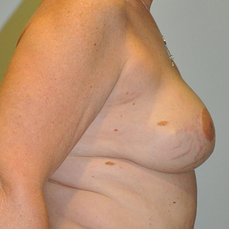 DIEP Flap Reconstruction Before & After Gallery - Patient 154952147 - Image 6