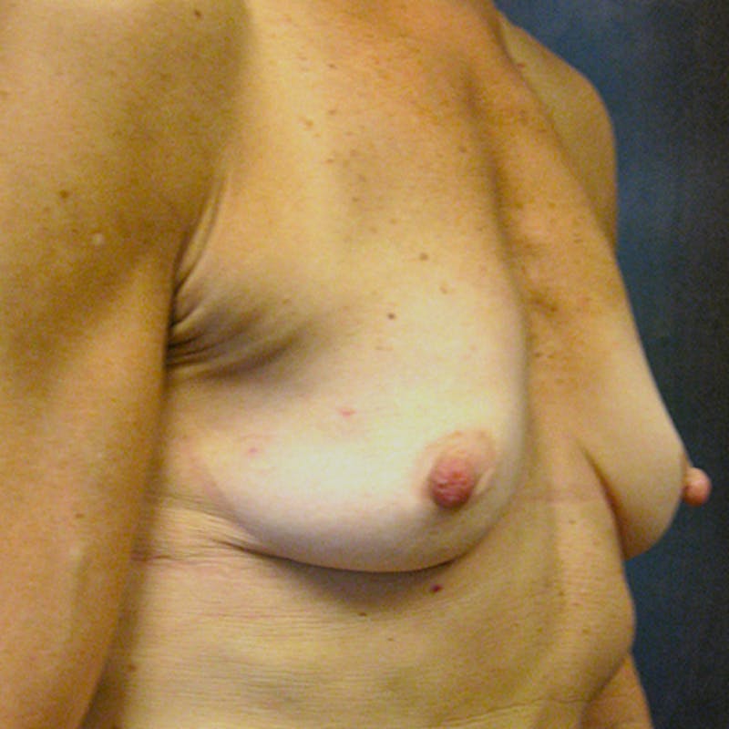 Nipple Sparing Breast Reconstruction Before & After Gallery - Patient 154952149 - Image 3