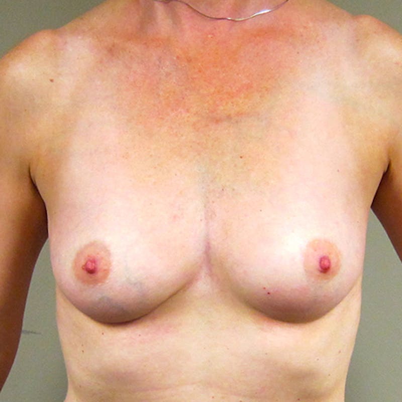 Silicone Breast Augmentation Before & After Gallery - Patient 154952154 - Image 1