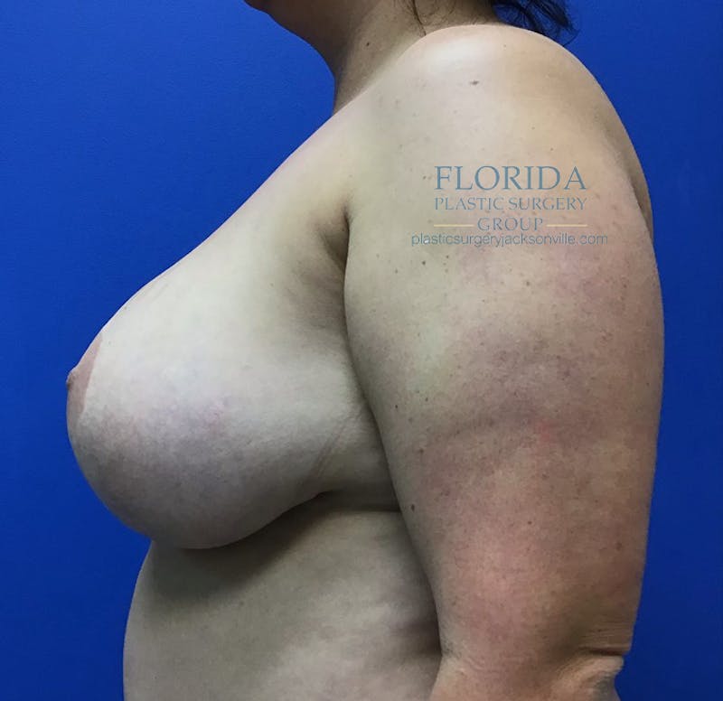 Breast Implant Removal Before & After Gallery - Patient 154952163 - Image 3