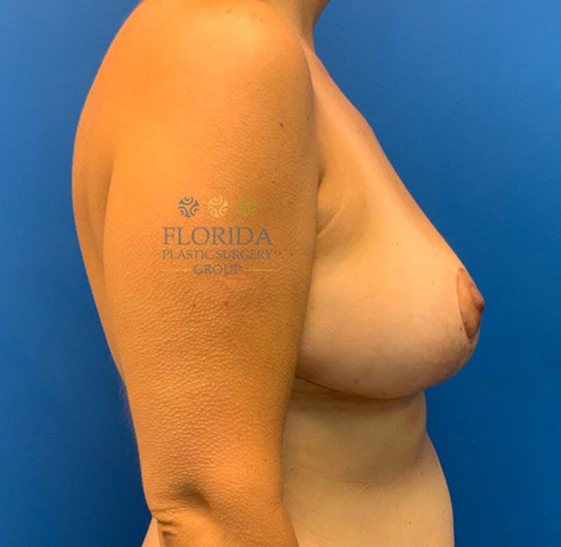 Breast Reduction Before & After Gallery - Patient 154952153 - Image 6