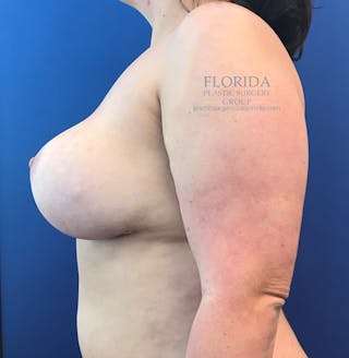 Breast Implant Removal Before & After Gallery - Patient 154952163 - Image 4