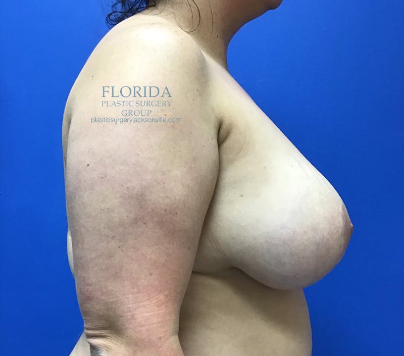 Breast Implant Removal Before & After Gallery - Patient 154952163 - Image 5