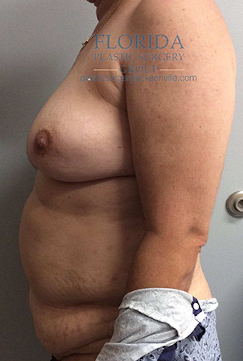 DIEP Flap Reconstruction Before & After Gallery - Patient 154952158 - Image 5
