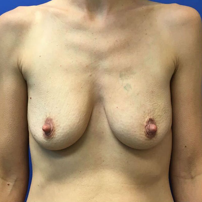 Nipple Sparing Breast Reconstruction Before & After Gallery - Patient 154952161 - Image 1