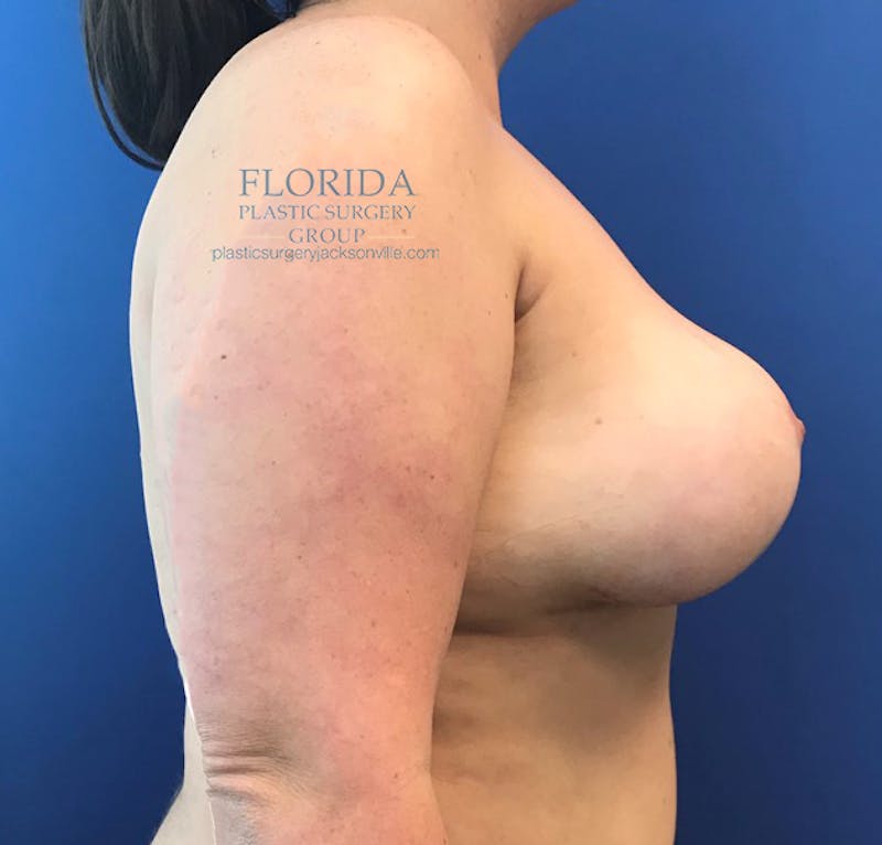 Breast Implant Removal Before & After Gallery - Patient 154952163 - Image 6