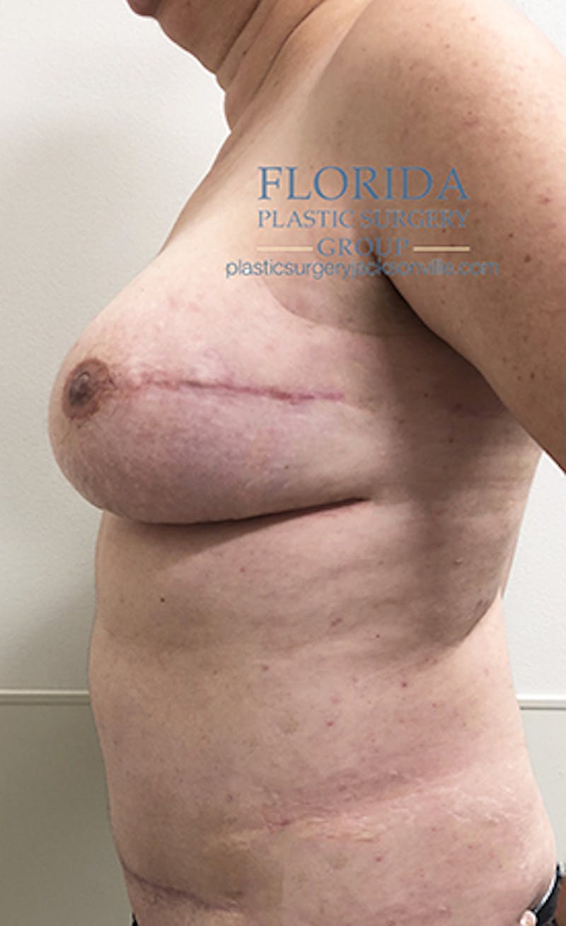DIEP Flap Reconstruction Before & After Gallery - Patient 154952158 - Image 6