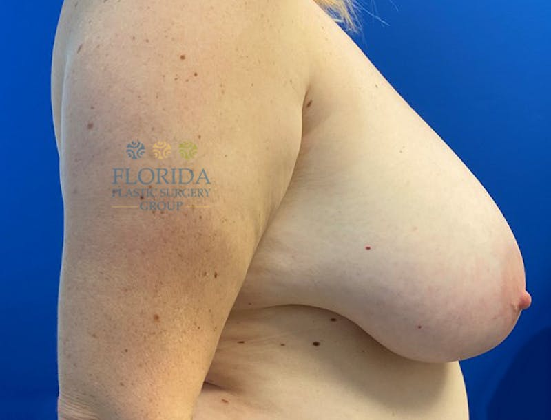 Breast Reduction Before & After Gallery - Patient 154952160 - Image 5